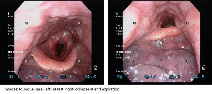 mp_ent_clinical_osa_2