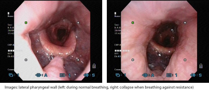 mp_ent_clinical_osa_3