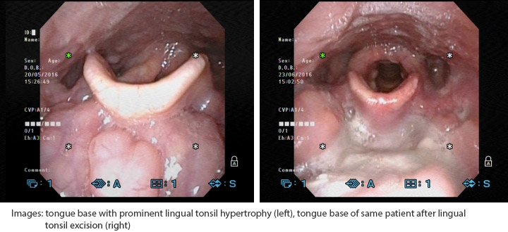 mp_ent_clinical_osa_4
