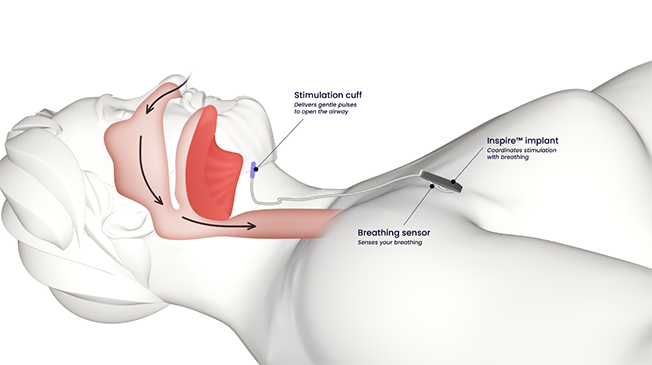 Hypoglossal Nerve Stimulation (HGNS)